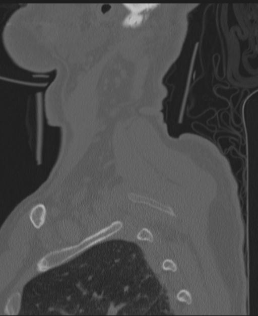 Cerebral hemorrhagic contusions and cervical spine fractures (Radiopaedia 32865-33841 Sagittal bone window 7).jpg