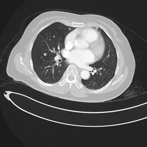 Cerebral metastases (Radiopaedia 33041-34055 Axial lung window 30).png