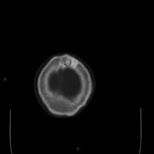 File:Cerebral metastases - breast primary (Radiopaedia 77653-89857 Axial bone window 111).jpg