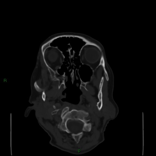 Cerebral metastases - breast primary (Radiopaedia 77653-89857 Axial bone window 6).jpg