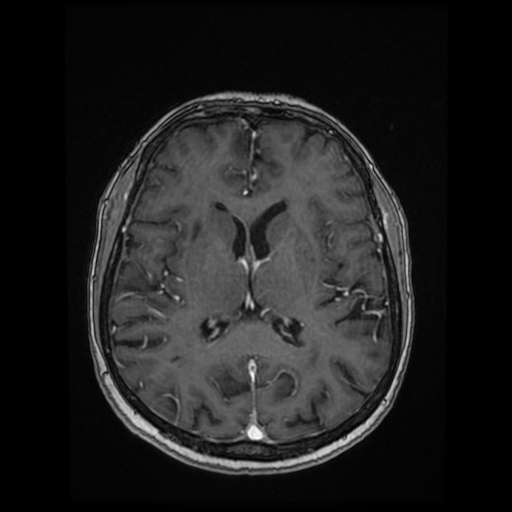 File:Cerebral metastases - melanoma (Radiopaedia 80972-94522 Axial T1 C+ 58).jpg