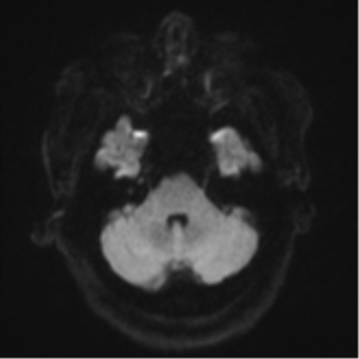 Cerebral metastases mimicking multifocal glioblastoma (Radiopaedia 50843-56353 Axial DWI 35).png
