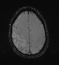 Cerebral metastasis - melanoma (Radiopaedia 54718-60954 Axial SWI 45).png