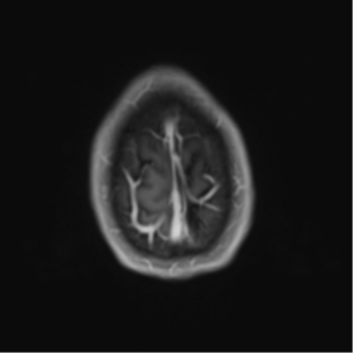 Cerebral metastasis - melanoma (Radiopaedia 54718-60954 Axial T1 C+ fat sat 48).png