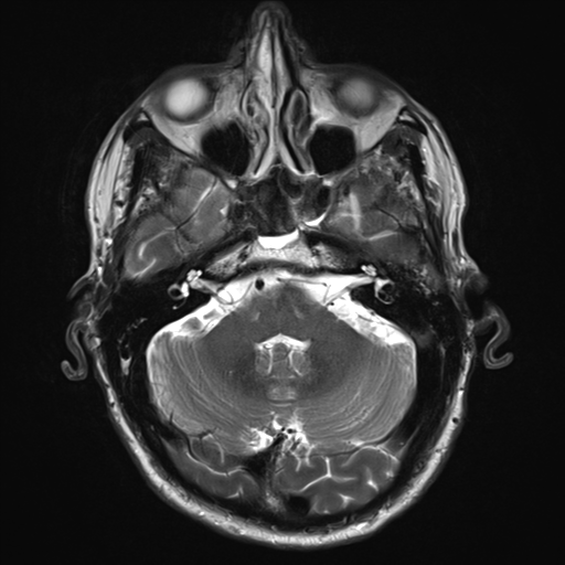 File:Cerebral metastasis - melanoma (Radiopaedia 54718-60954 Axial T2 8).png