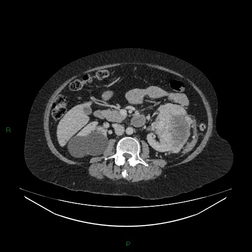 Cerebral metastasis from renal cell carcinoma (Radiopaedia 82306-96378 A 82).jpg