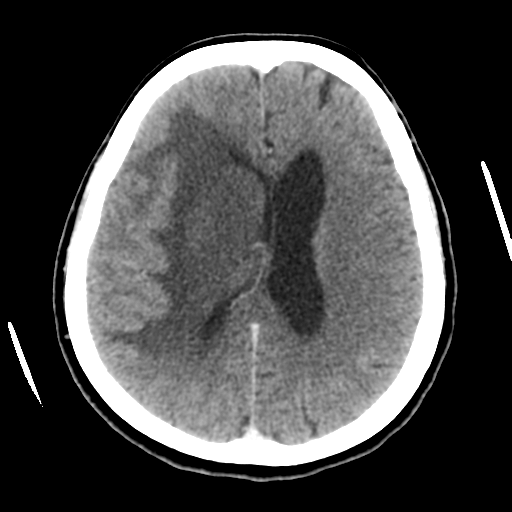 Cerebral metastasis to basal ganglia (Radiopaedia 81568-95412 Axial C+ delayed 37).png