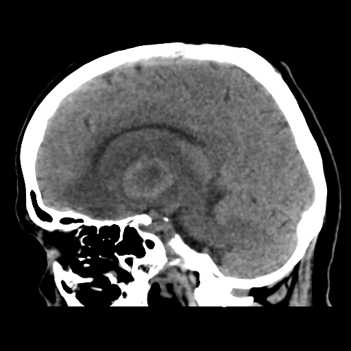 Cerebral metastasis to basal ganglia (Radiopaedia 81568-95412 E 28).png