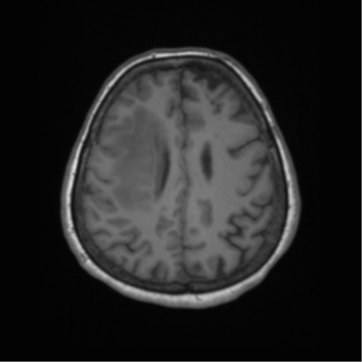 Cerebral metastasis to basal ganglia (Radiopaedia 81568-95413 Axial T1 53).png