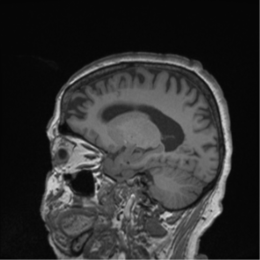 Cerebral metastasis to basal ganglia (Radiopaedia 81568-95413 Sagittal T1 24).png