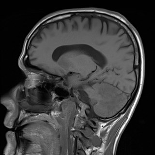 File:Cerebral toxoplasmosis (Radiopaedia 43956-47461 Sagittal T1 8).jpg