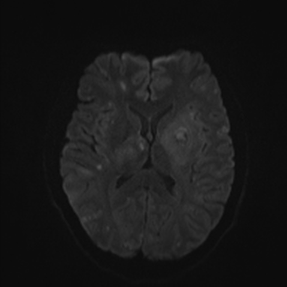 Cerebral toxoplasmosis (Radiopaedia 53993-60132 Axial DWI 42).jpg