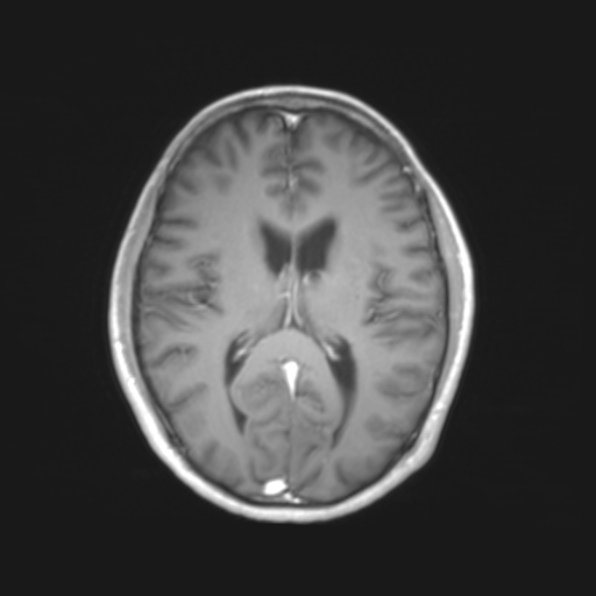 File:Cerebral toxoplasmosis (Radiopaedia 53993-61435 Axial T1 13).jpg