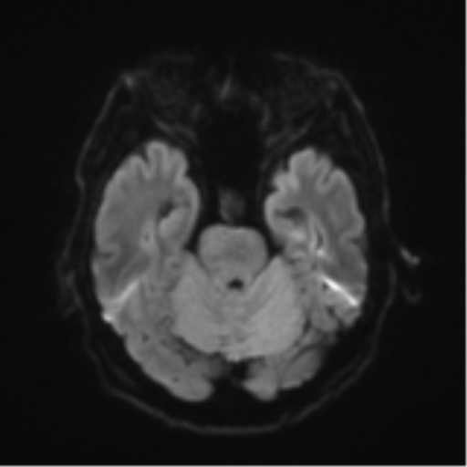 Cerebral toxoplasmosis (Radiopaedia 54575-60804 Axial DWI 44).png