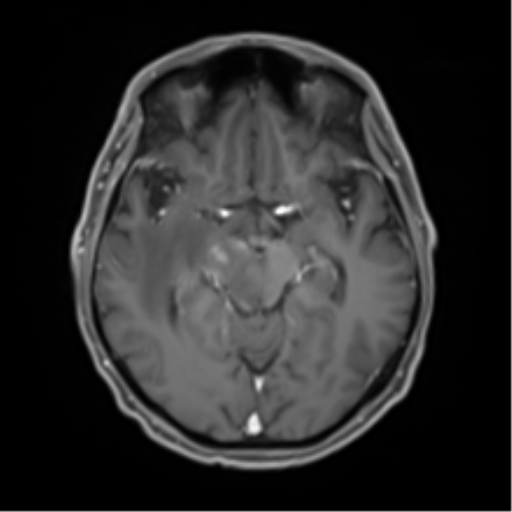 Cerebral toxoplasmosis (Radiopaedia 54575-60804 Axial T1 C+ 24).png