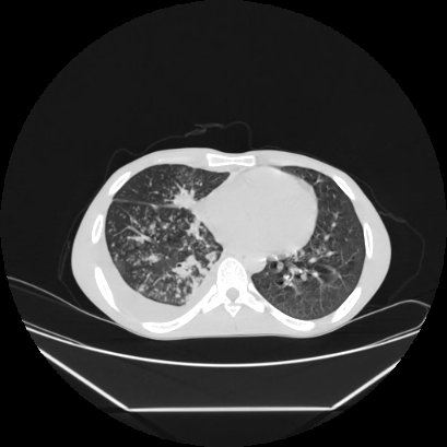 Cerebral tuberculoma (Radiopaedia 80829-94318 Axial lung window 112).jpg