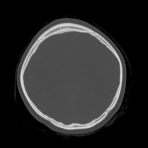 Cerebral tuberculosis with dural sinus invasion (Radiopaedia 60353-68018 Axial bone window 47).jpg