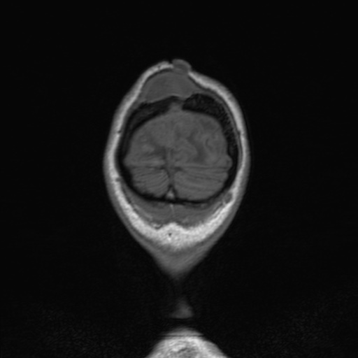 Cerebral tuberculosis with dural sinus invasion (Radiopaedia 60353-68090 Coronal T1 169).jpg