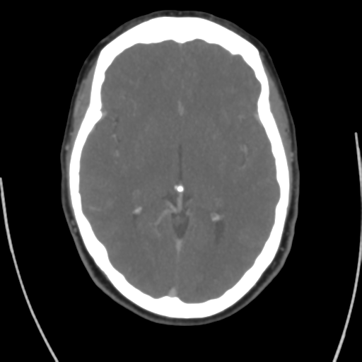Cerebral venous infarct related to dural venous sinus thromboses (Radiopaedia 35292-36804 Axial C+ delayed 24).png