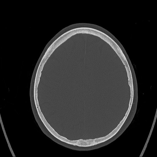 Cerebral venous infarction with hemorrhage (Radiopaedia 65343-74381 Axial bone window 138).jpg