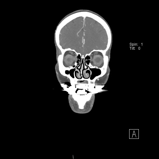 Cerebral venous infarction with hemorrhage (Radiopaedia 65343-74396 B 58).jpg