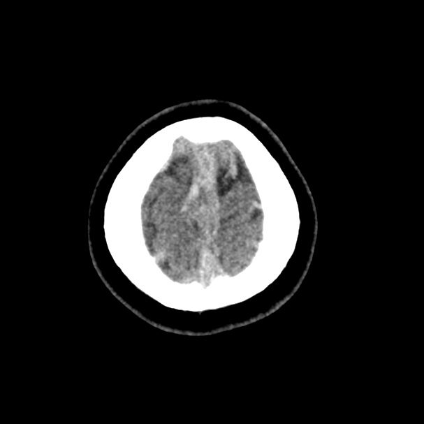 Cerebral venous sinus thrombosis (Radiopaedia 59224-66551 Axial non-contrast 55).jpg