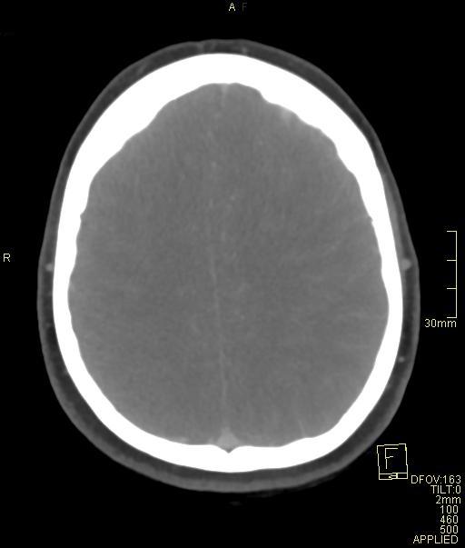 Cerebral venous sinus thrombosis (Radiopaedia 91329-108965 Axial venogram 61).jpg