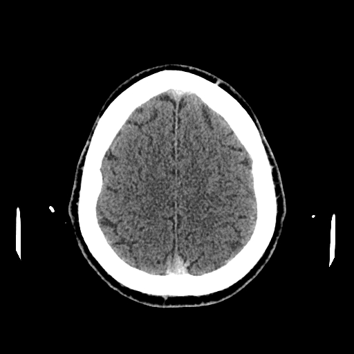File:Cerebral venous thrombosis (CVT) (Radiopaedia 77524-89685 Axial non-contrast 39).jpg