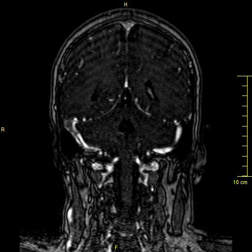 File:Cerebral venous thrombosis (Radiopaedia 23288-23351 MRV 112).JPG