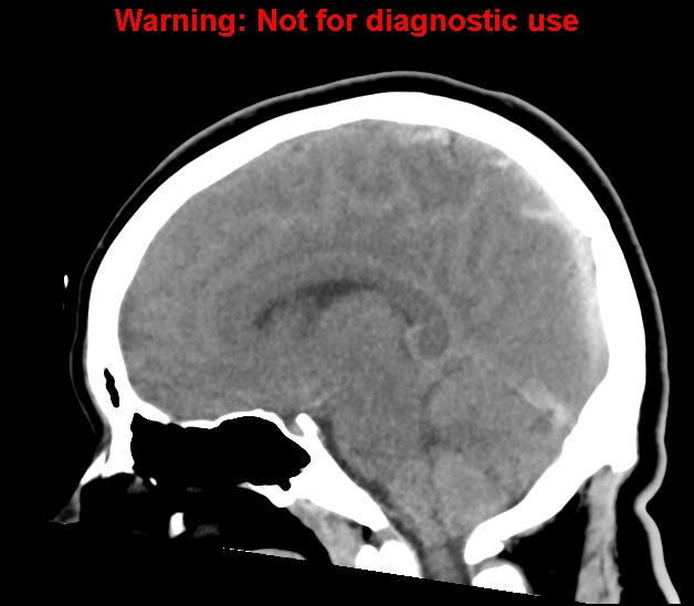File:Cerebral venous thrombosis (Radiopaedia 37224-38992 B 17).jpg