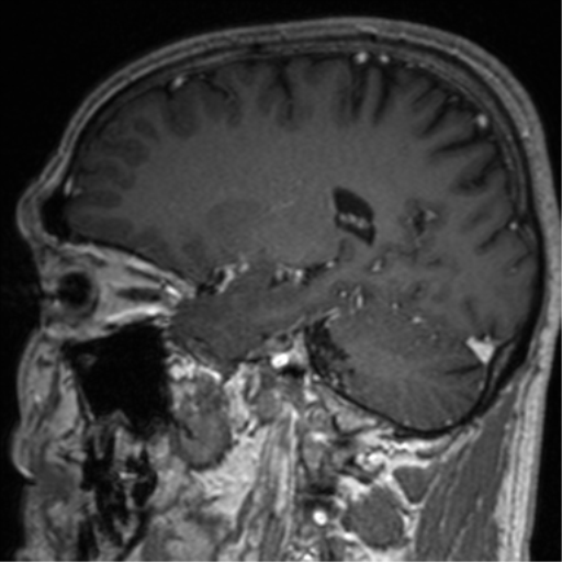 File:Cerebral venous thrombosis (Radiopaedia 38392-40469 Sagittal T1 C+ 57).png