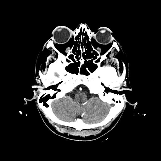 File:Cerebral venous thrombosis with venous hemorrhagic infarct (Radiopaedia 90354-107660 Axial with contrast 33).jpg