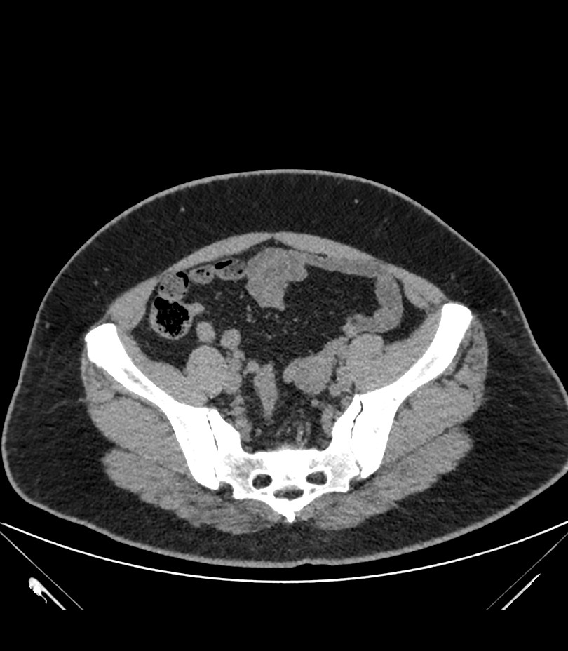 Cervical aortic arch with coarctation and aneurysms (Radiopaedia 44035-47552 Axial non-contrast 82).jpg