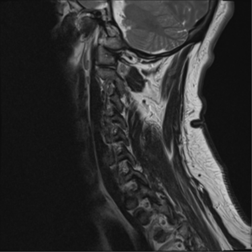 File:Cervical canal stenosis due to ossification of the posterior longitudinal ligament (Radiopaedia 47260-51824 Sagittal T2 13).png