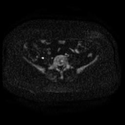 File:Cervical carcinoma (Radiopaedia 67644-77047 Axial DWI 1).jpg