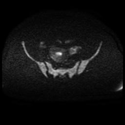 Cervical carcinoma (Radiopaedia 88010-104555 Axial DWI 77).jpg