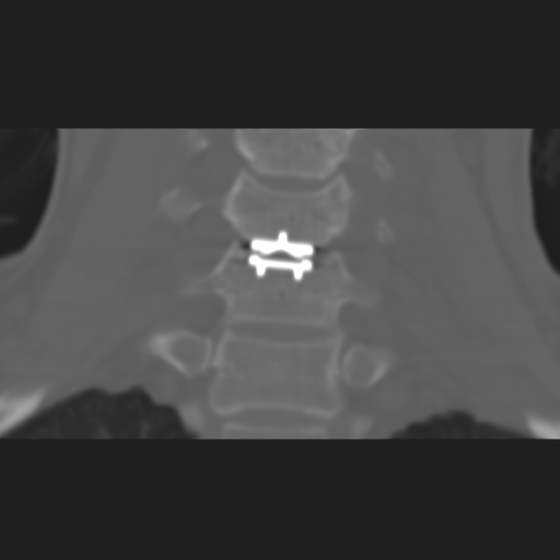 File:Cervical disc replacement (Radiopaedia 37383-39205 Axial bone window 1).png