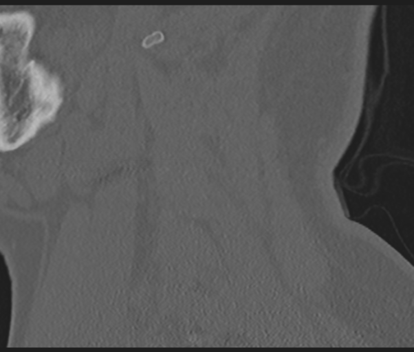 File:Cervical disc replacement (Radiopaedia 44025-47541 Sagittal bone window 15).png