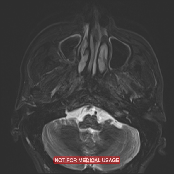 File:Cervical nerve schwannoma (Radiopaedia 27964-28221 C 15).jpg