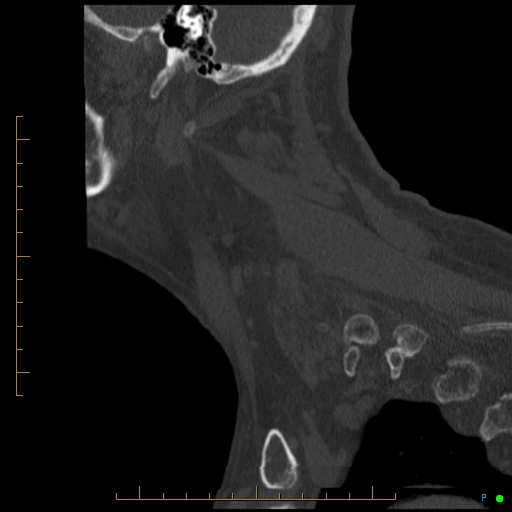 Cervical spine fracture - ankylosing spondylitis (Radiopaedia 76835-88706 Sagittal bone window 20).jpg