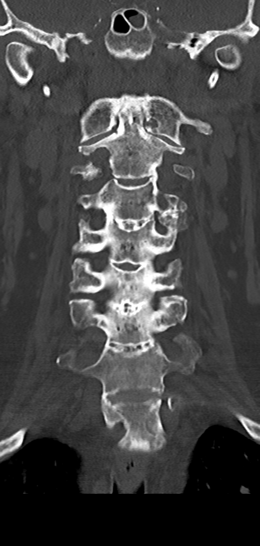 Cervical spine fracture - chalk stick (Radiopaedia 39116-41323 Coronal bone window 21).png