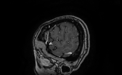 Cervical spondylodiscitis and calvarial hemangioma (Radiopaedia 64317-73103 Sagittal T1 C+ 6).jpg