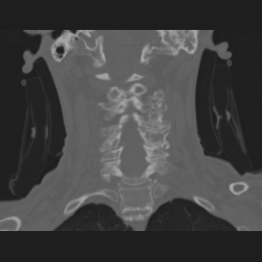 File:Cervical spondylolysis (Radiopaedia 49616-54811 Sagittal bone window 1).png
