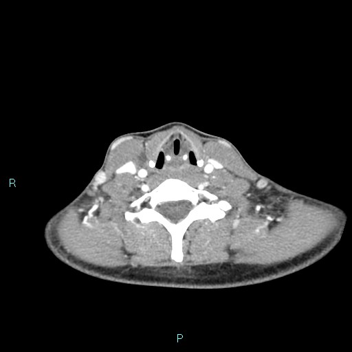 Cervical thymic cyst (Radiopaedia 88632-105335 B 46).jpg
