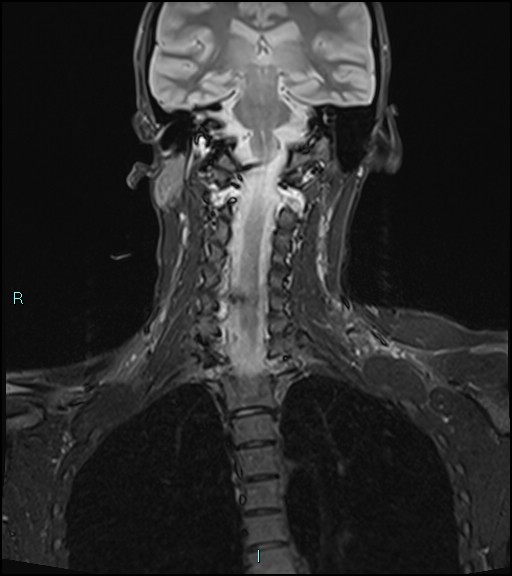 File:Cervical thymic cyst (Radiopaedia 88632-105336 Coronal STIR 27).jpg