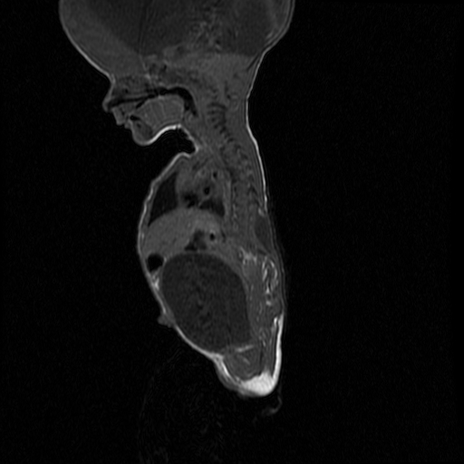 File:Chiari II malformation with spinal meningomyelocele (Radiopaedia 23550-23652 Sagittal T1 4).jpg