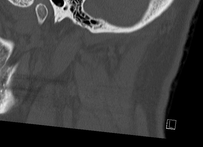 Chiari I malformation with a symptomatic syrinx of the posterolateral medulla oblongata (Radiopaedia 42573-45707 A 8).jpg