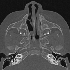 Choanal atresia (Radiopaedia 88525-105975 Axial bone window 28).jpg