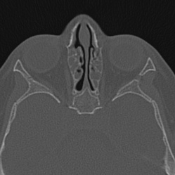 Choanal atresia (Radiopaedia 88525-105975 Axial bone window 71).jpg