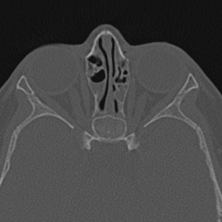 Choanal atresia (Radiopaedia 88525-105975 Axial bone window 79).jpg
